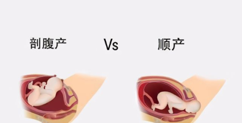 婆婆要我顺产，顺产比剖腹产好吗？