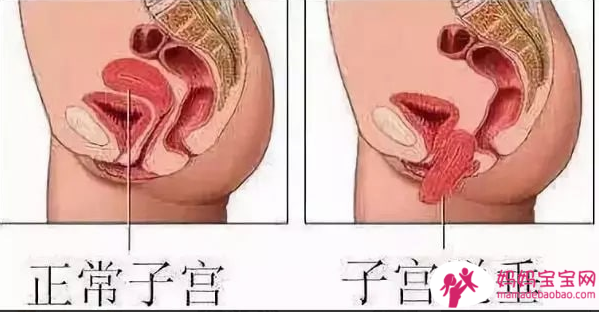 研究质疑分娩方式与盆底症状之间的关系