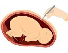 自然产、剖腹产好处坏处有哪些?优缺点一次搞清楚