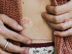 剖腹产：这5个做法助子宫恢复
