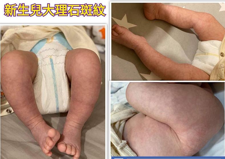 宝宝冬天皮肤面的「紫紫花花」父母好担心！儿科医师：免担心，不是生病！