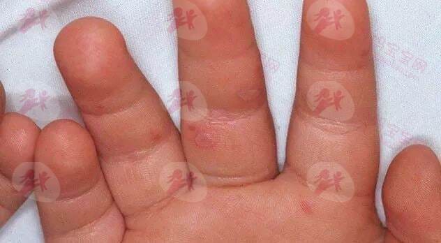 宝宝得了手足口病怎么办？宝宝手足口病护理&预防指南
