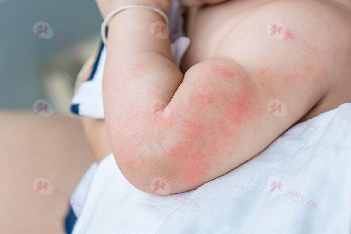 宝宝得了手足口病怎么办？宝宝手足口病护理&预防指南