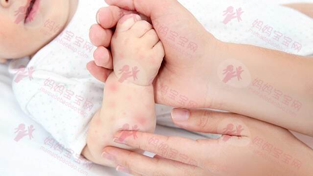 宝宝几个月可以用驱蚊剂？宝宝被蚊虫叮咬后怎么办？