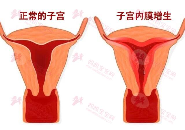 子宫内膜炎能怀上孩子吗？