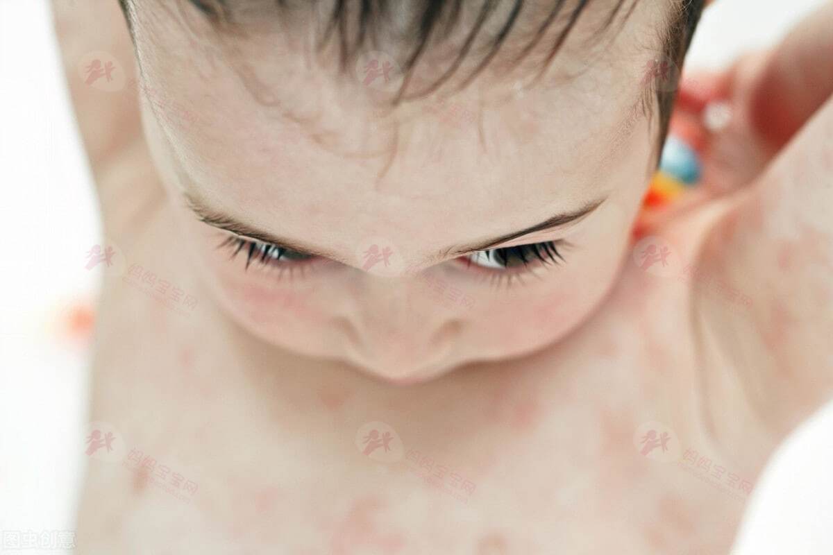湿疹护理难？除了膏药，还有这些护理方法一定要注意