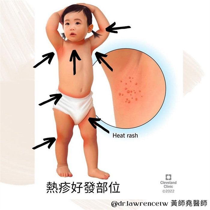 有一种冷叫大人觉得冷天凉宝 宝却热疹却冒不停，儿科医：穿太多啦