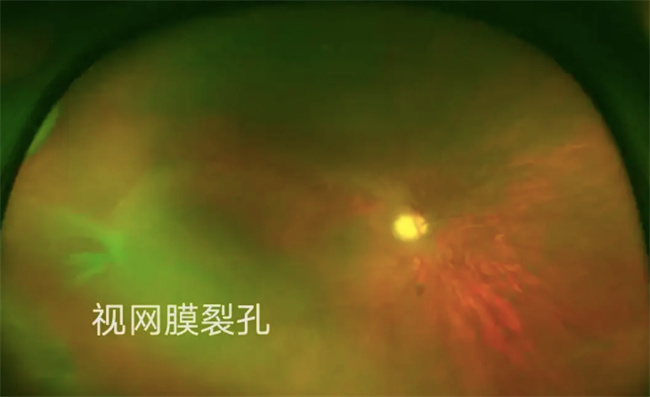 早产儿视网膜病变都有哪些症状