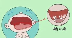小儿鹅口疮是什么原因引起的（白色念珠菌感染）