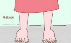 可以缓解产前水肿和腰痛的小妙招（热敷、休息、按摩、适当运动）