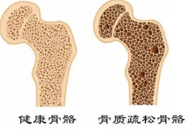 预防骨质疏松症的方法