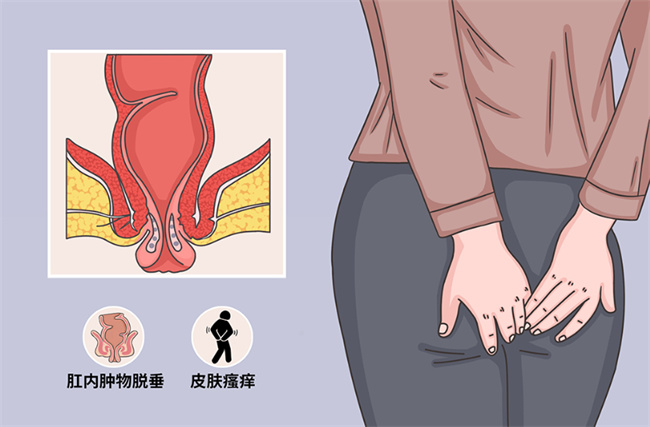 肛脱有哪些危害