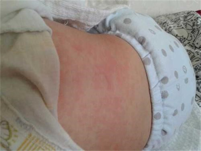 幼儿出急疹是否可以出门