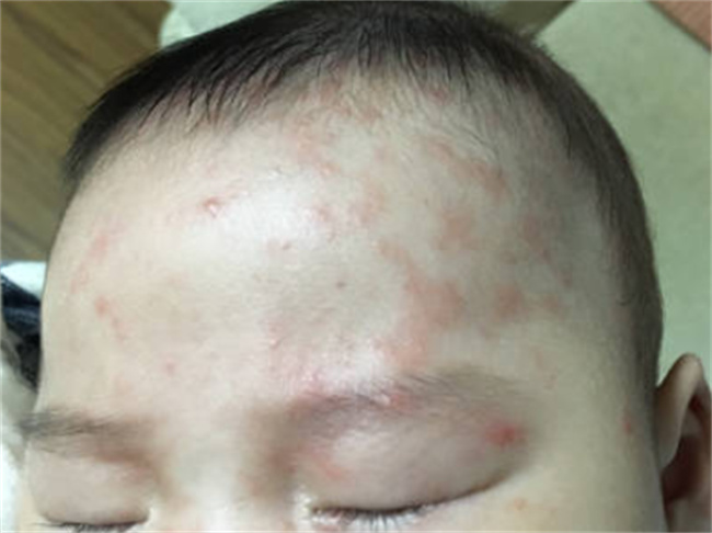 幼儿出急疹是否可以出门