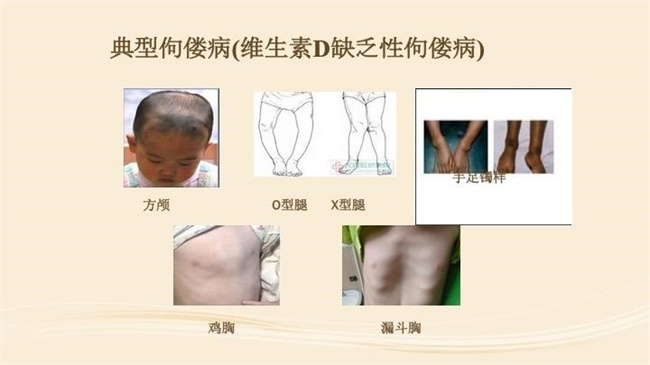 佝偻病会不会遗传