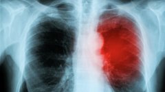 探秘隐球菌肺炎：病因、症状与治疗