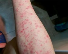 艾滋病防控：知识，预防，保护自己