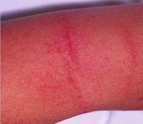 当宝宝上幼儿园：解析猩红热，你需要知道的一切