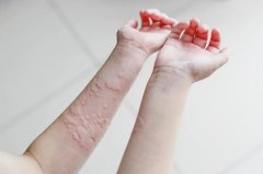 揭秘荨麻疹的过敏原，了解病因助你科学对待