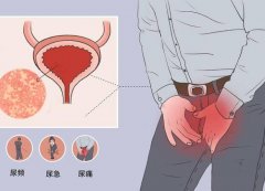 解读非淋菌性尿道炎：病因、症状与治疗方法