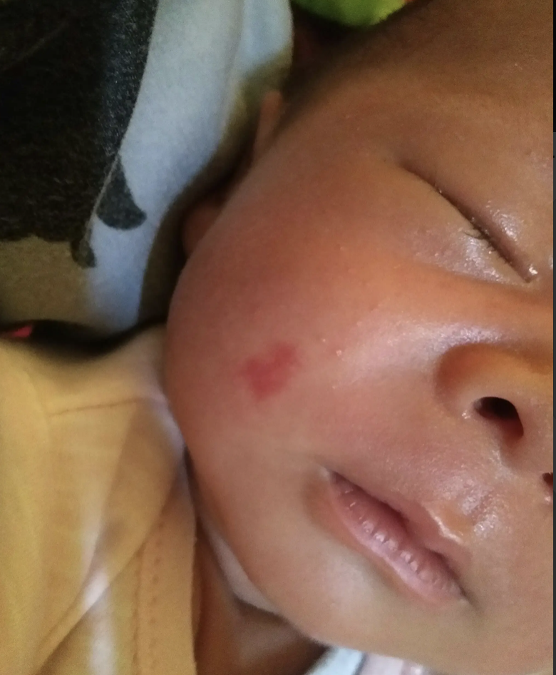 女童脸上留下床母胎记，6年治疗、针孔上百，她依然笑脸迎人！妈妈心痛：疗程遥遥无期