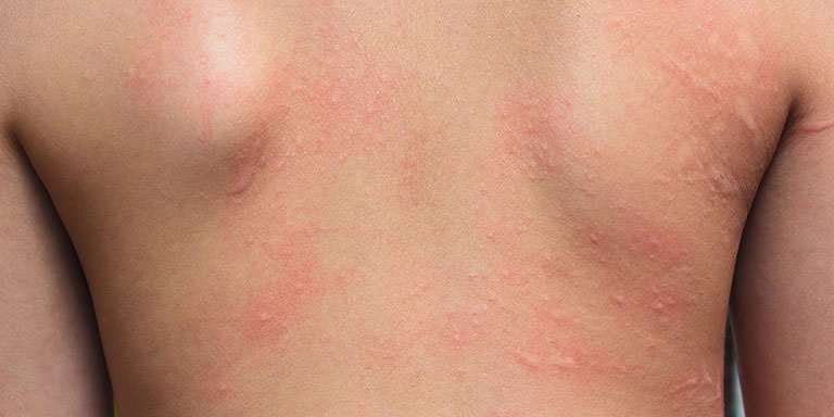 6种让孩子在皮肤上漂浮的疾病,不要小看