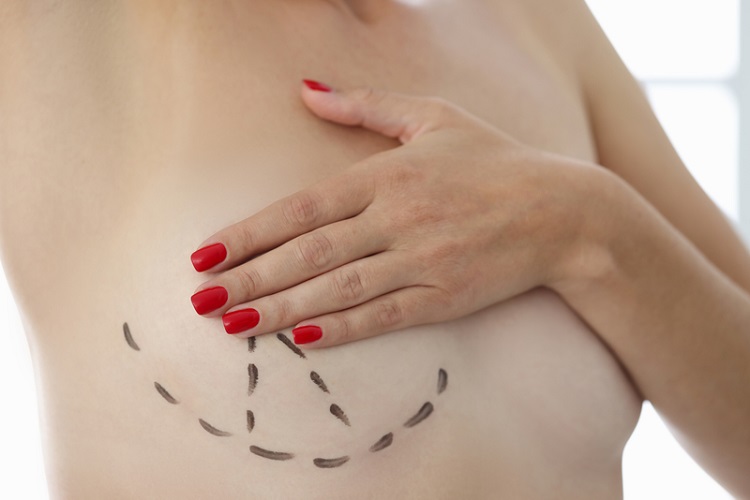何时需进行「预防性全乳房切除手术」？ 权威医点名「1类人」：罹乳癌机率高