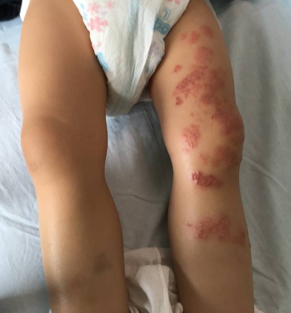 1岁多女童竟长皮蛇，吓坏妈！医：水痘疫苗引起带状疱疹，打两剂保护力更好