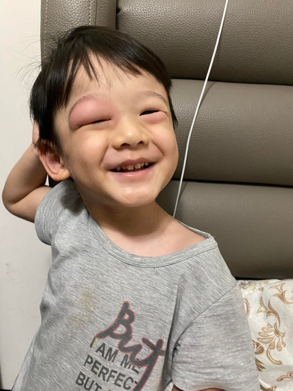 3岁童被蚊叮，眼周红肿热痛年幼孩子易对对蚊虫过敏！