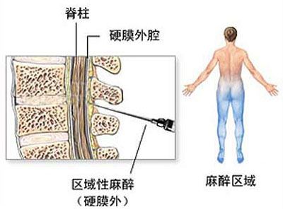 图解剖腹产全过程