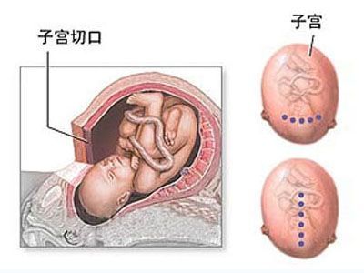 图解剖腹产全过程