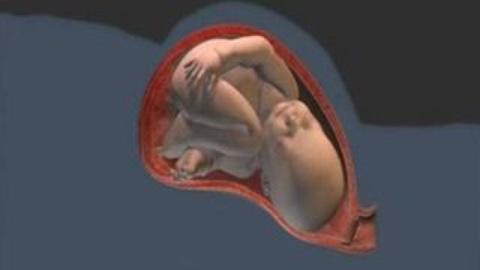 剖腹产手术动画模拟全过程