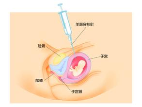 35岁以上的高龄孕妇建议产前做“羊水穿刺”检查