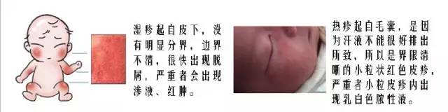 湿疹与热疹怎样区分，湿疹宝宝如何洗澡护肤、用药、打预防针？