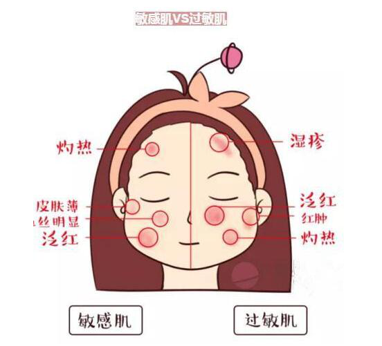 怎么能把过敏感肌 激素脸治好，修复脸肌首选欧丝丽曼