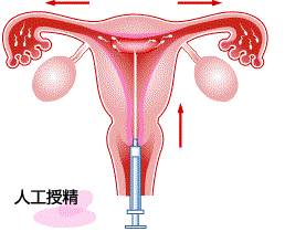 人工授精or试管婴儿，应该如何选择？