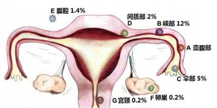 宫外孕是什么意思?宫外孕应该怎么办?