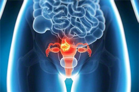 卵巢癌的早期症状 女人们一定要知道这几点