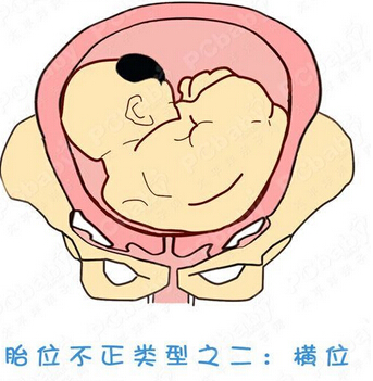 正常胎位图和胎位不正图