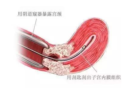 影响试管成功率的三大常见妇科疾病有哪些？什么是宫腔粘连