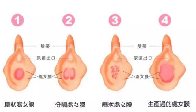 处女膜是什么样子的？处女膜有哪些形状？