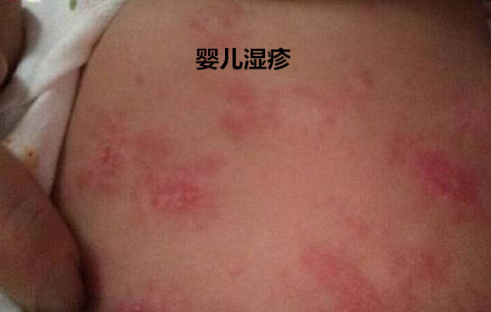 婴儿湿疹和热疹的区别 牢记六大区别不再混淆