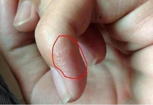 手指上起小水泡：汗疱疹千万不挠它（图）