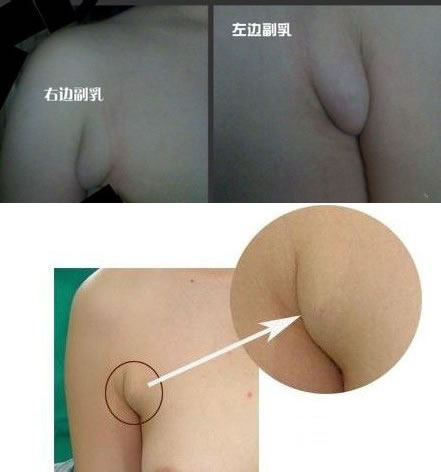 副乳怎么办：坚持运动按摩效果好（图）