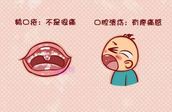 鹅口疮症状及鉴别图片 简单两个步骤就可以轻松搞定