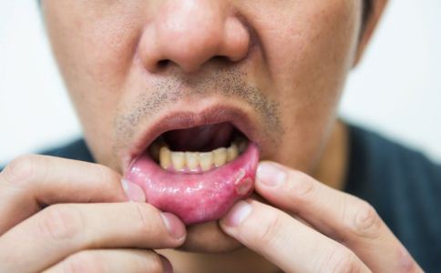 引起口腔溃疡原因有哪些 应对口腔溃疡的小妙招