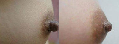 乳头乳晕缩小