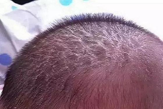 傻傻分不清?奶藓和湿疹的区别图片看这里