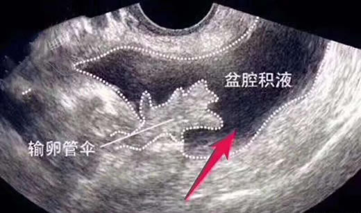 盆腔积液20mm能自愈吗