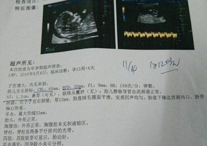 nt单子上胎心心率可以看出男女吗,nt值小于1一定是女孩吗?